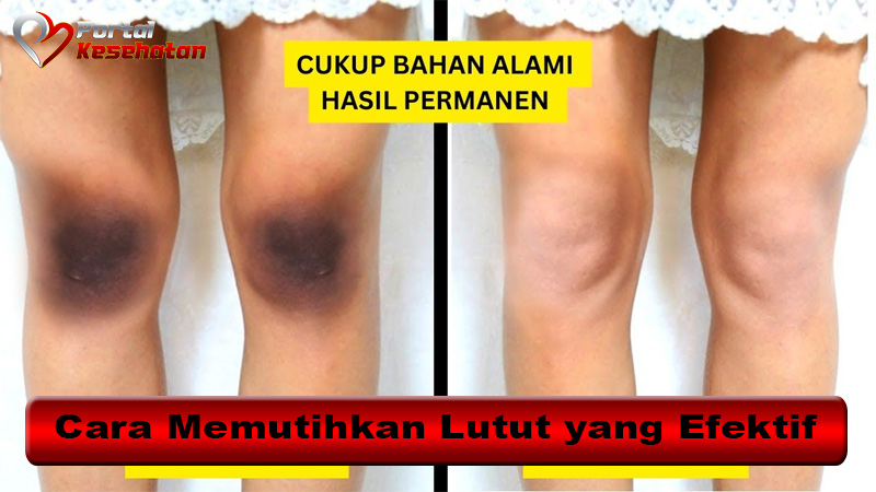 Cara Memutihkan Lutut yang Efektif